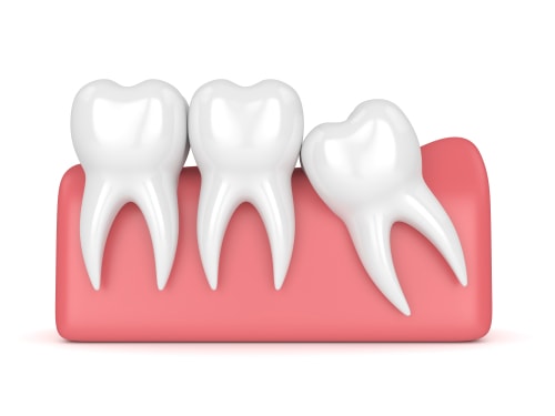 What Happens if You Don't Get Your Wisdom Teeth Removed?